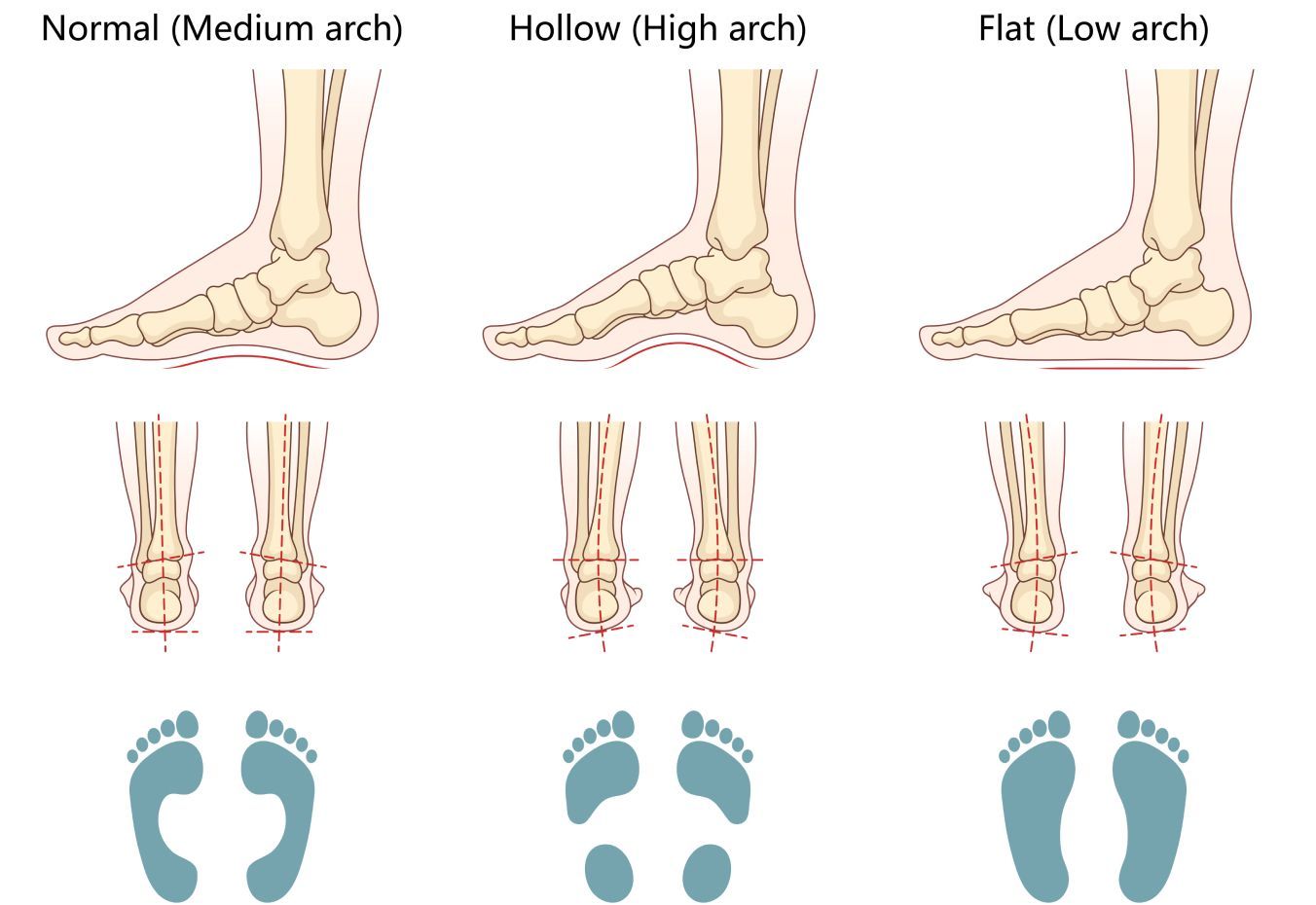 An info graphic on flat feet.